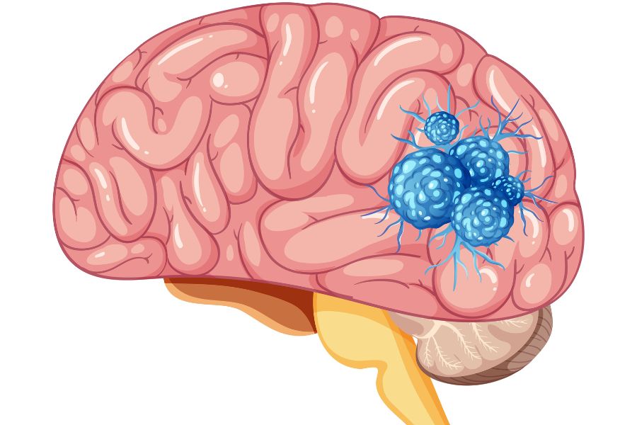 Brain Tumour Treatment