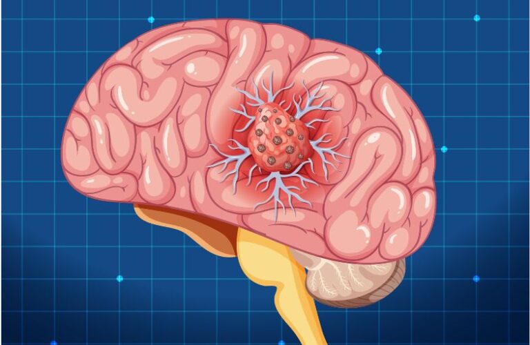 Brain Tumours