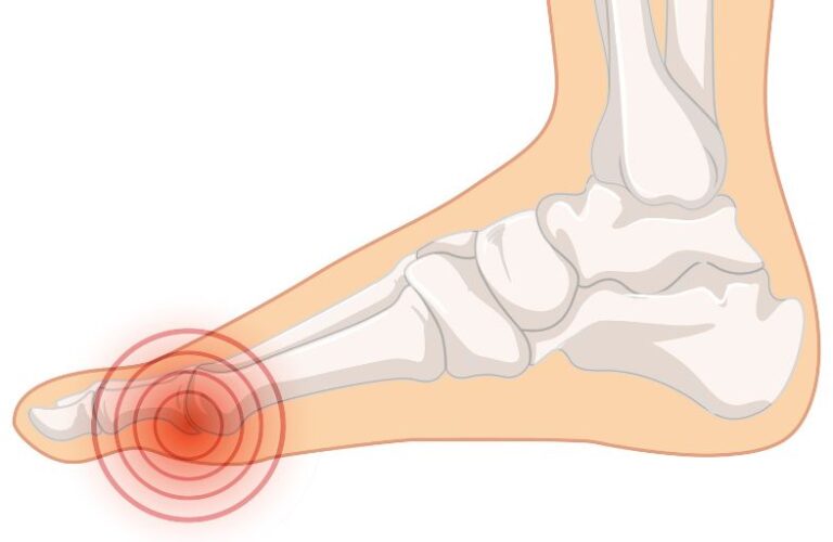 Neuropathy