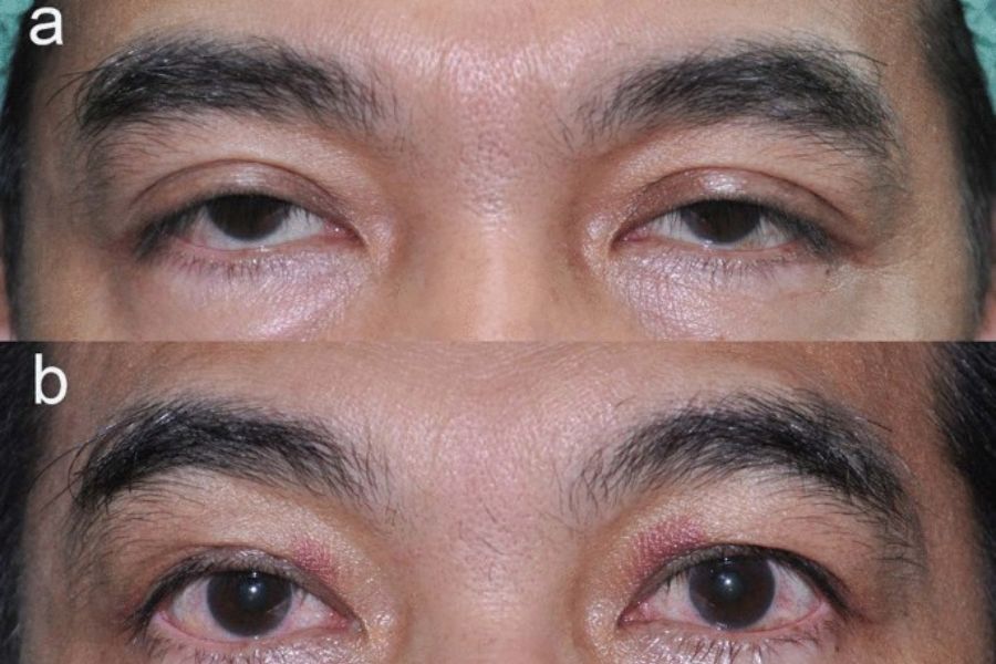 Myasthenia Gravis Treatment in wakad