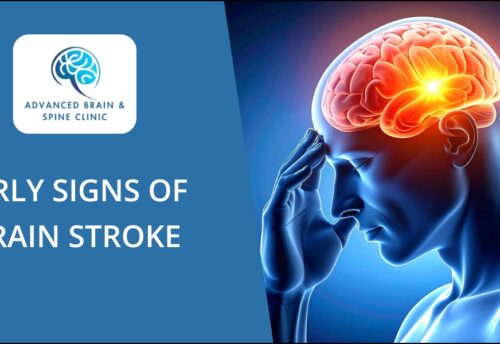 Brain Stroke Treatment